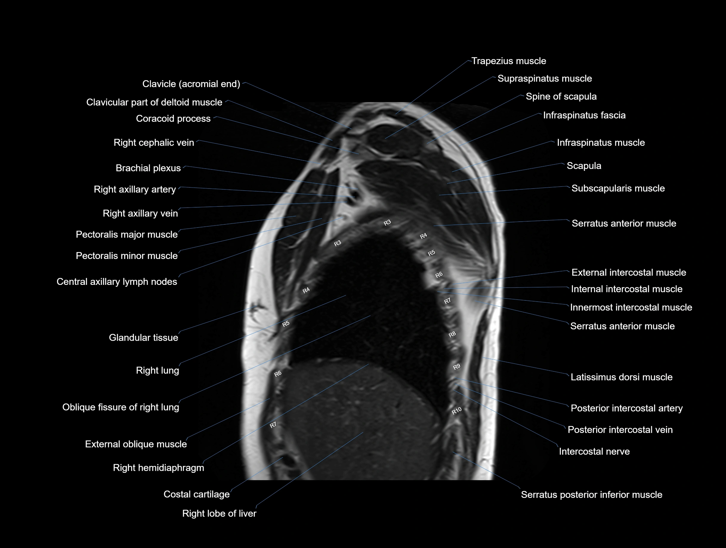 MRI chest (thorax) coronal  cross sectional anatomy 3T radiology  image-img-00001-00007.webp